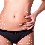 Decreasing swelling after liposuction