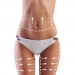 Length of the scar after a tummy tuck