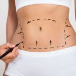 Liposuction is not a weight loss program