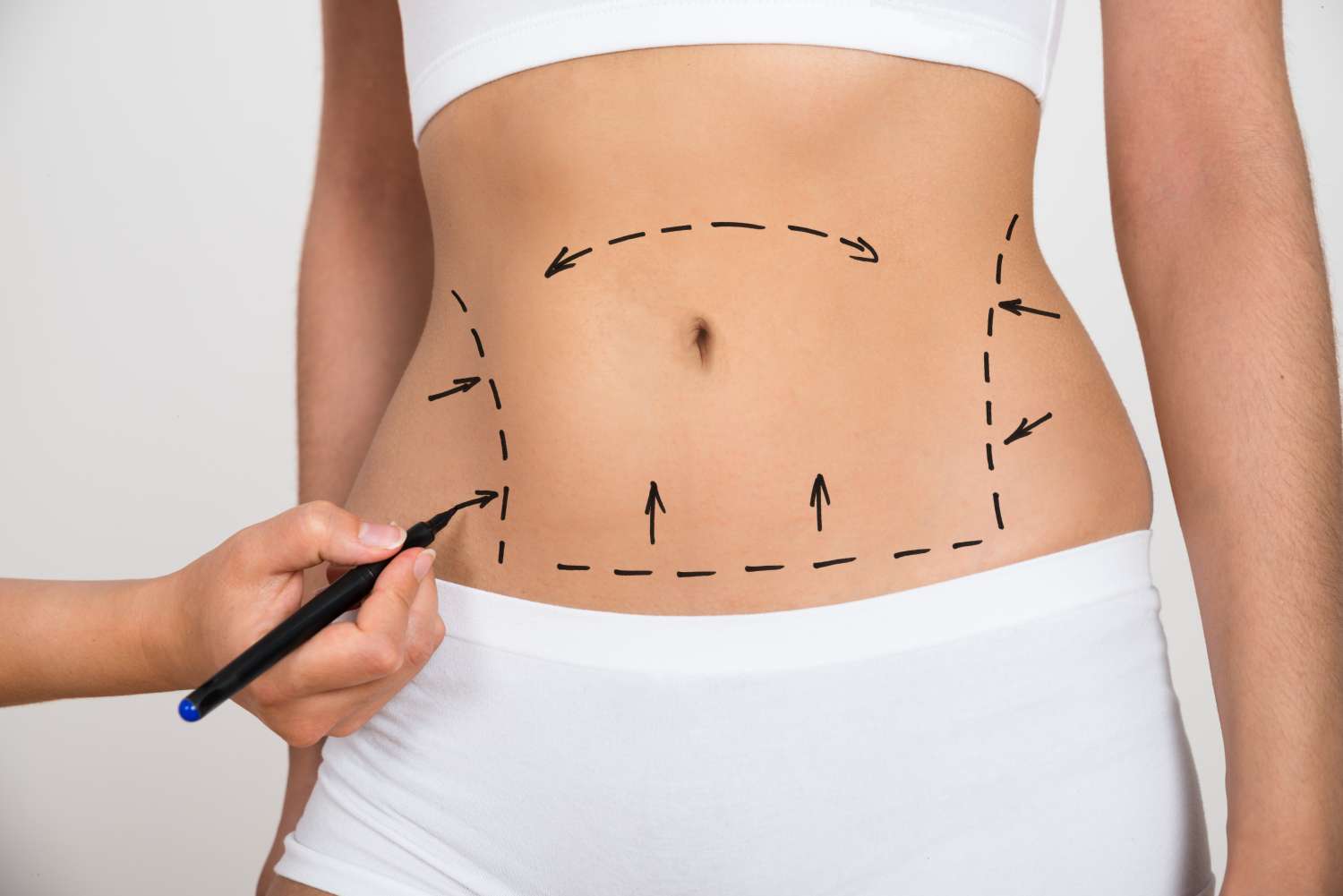 Liposuction is not a weight loss program